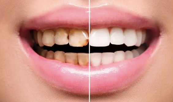 Evde Diş Beyazlatma Yöntemleri Nelerdir?