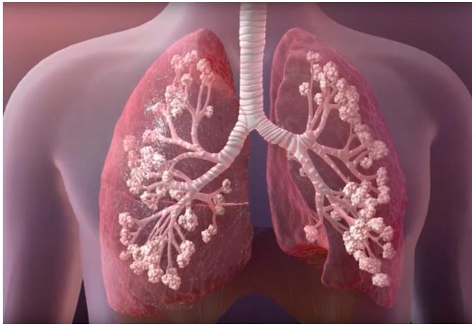 Kistik Fibrozis (KF) Nedir Belirtileri Nelerdir